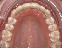 Efter – Patient 2a