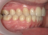 Efter – Patient 4a