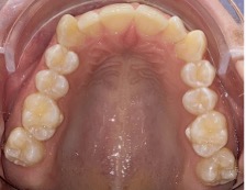 Före – Patient 2a