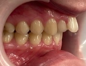 Före – Patient 4a